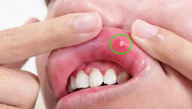 B Vitamini Eksikliğinde Dikkat Edilmesi Gereken 5 Belirgin Belirti