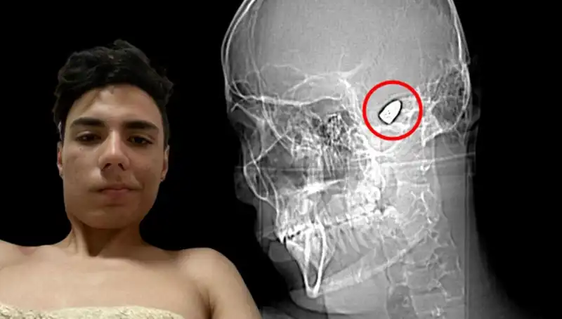 Kafasında Patlamaya Hazır Bomba İle Yaşayan Genç: Hayatta Kalma Mücadelesi